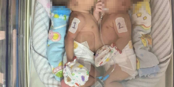 Bayi Kembar Siam Asal Ciawigajah Selalu Dipantau Dokter