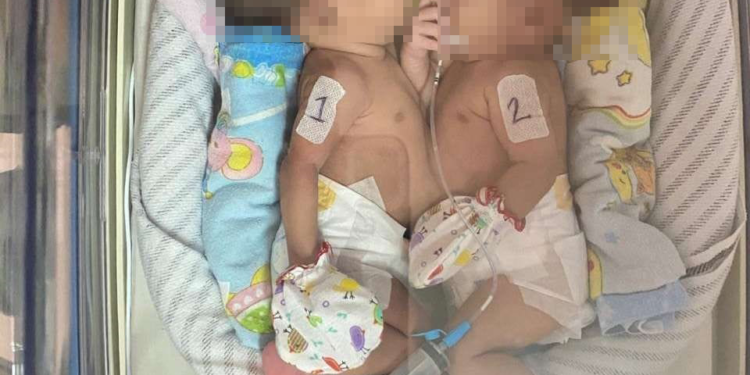 Bayi Kembar Siam Asal Ciawigajah Selalu Dipantau Dokter