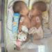 Bayi Kembar Siam Asal Ciawigajah Selalu Dipantau Dokter