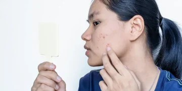 Tips Menghilangkan Bekas Jerawat yang Membandel