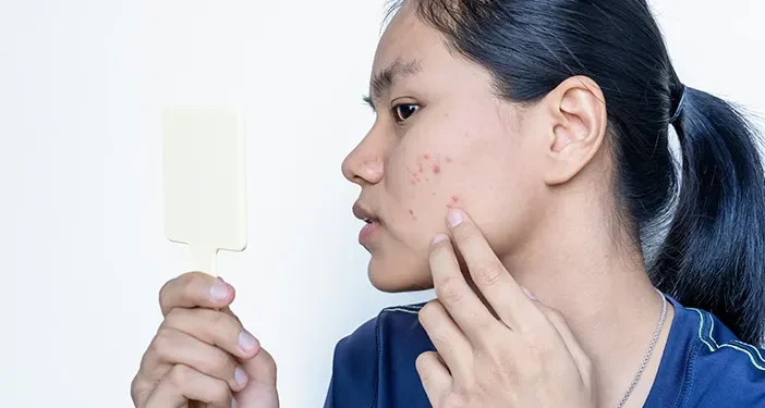 Tips Menghilangkan Bekas Jerawat yang Membandel