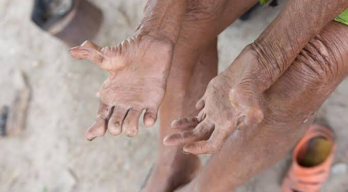 Kasus Kusta di Kabupaten Cirebon Capai 177 Kasus, Talun dan Pangenan Tertinggi